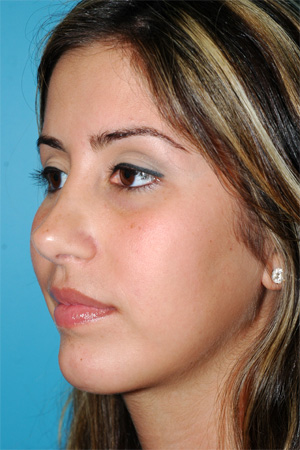 Richard Davis, MD Primary Rhinoplasty: Patient 7, Oblique View, Post-Op