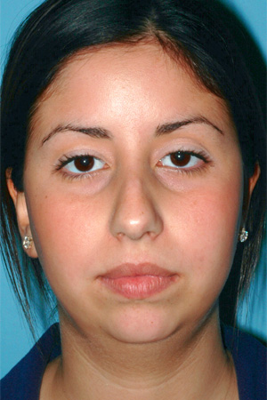 Richard Davis, MD Primary Rhinoplasty: Patient 7, Front View, Pre-Op
