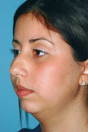 Richard Davis, MD Primary Rhinoplasty: Patient 7, Oblique View, Pre-Op