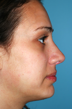 Richard Davis, MD Chin Augmentation: Patient 4, Profile View, Post-Op