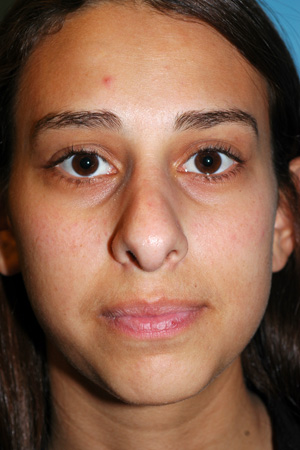 Richard Davis, MD Revision Rhinoplasty: Patient 7, Front View, Pre-Op