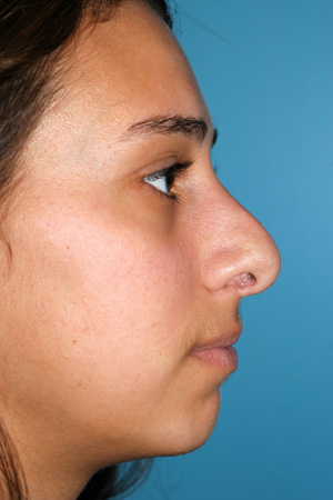 Richard Davis, MD Revision Rhinoplasty: Patient 7, Profile View, Pre-Op