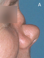 Cocaine Nose Deformity - Before Surgery