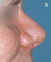 Cocaine Nose Deformity - After Surgery
