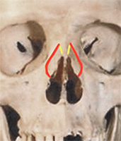 Human Skull Showing Lateral and Medial Osteotomy Cuts