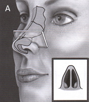Nasal Valve Area
