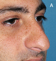 Caudal Excess Nasal Deformity - Before Surgery