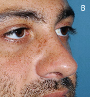 Caudal Excess Nasal Deformity - After Tongue-in-Groove Setback Procedure