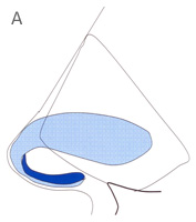 Alar (Tip) Cartilages - Profile View