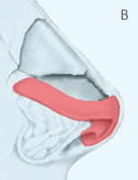 Alar Cartilage After Cephalic Trim