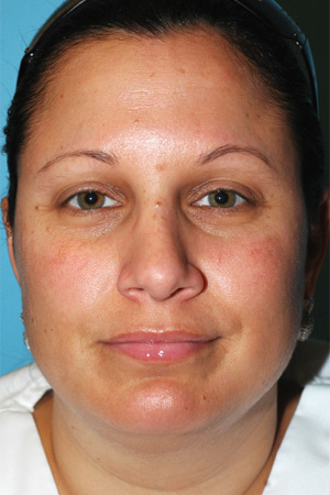 Richard Davis, MD Primary Rhinoplasty: Patient 10, Front View, Post-Op