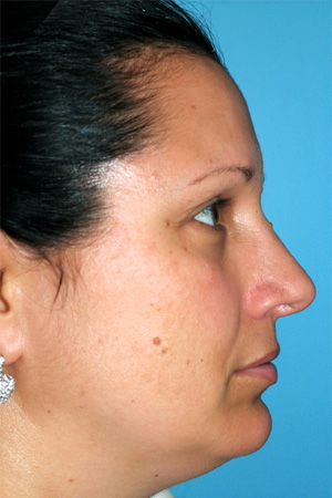 Richard Davis, MD Primary Rhinoplasty: Patient 10, Profile View, Post-Op