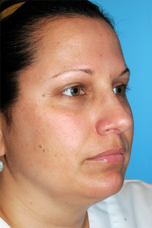 Richard Davis, MD Primary Rhinoplasty: Patient 10, Oblique View, Post-Op