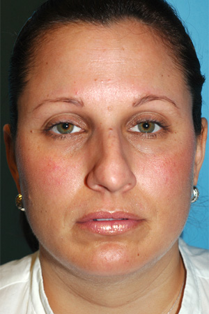 Richard Davis, MD Primary Rhinoplasty: Patient 10, Front View, Pre-Op