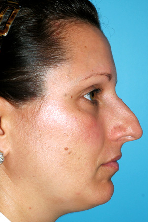 Richard Davis, MD Primary Rhinoplasty: Patient 10, Profile View, Pre-Op