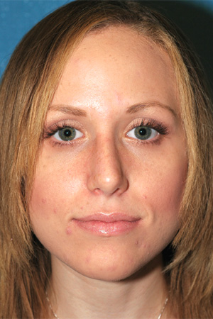 Richard Davis, MD Primary Rhinoplasty: Patient 11, Front View, Post-Op