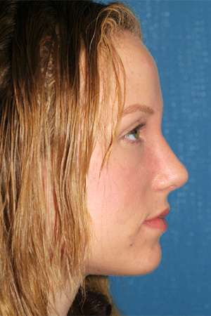 Richard Davis, MD Primary Rhinoplasty: Patient 11, Profile View, Post-Op