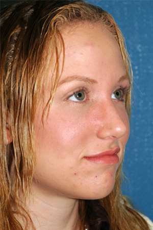 Richard Davis, MD Primary Rhinoplasty: Patient 11, Oblique View, Post-Op