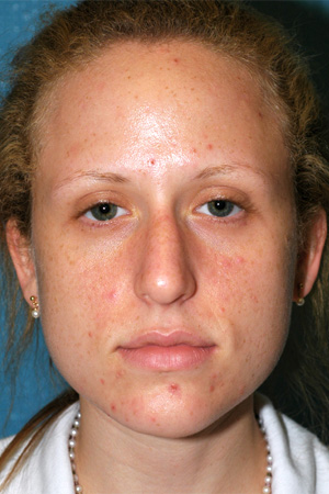 Richard Davis, MD Primary Rhinoplasty: Patient 11, Front View, Pre-Op