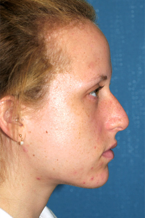 Richard Davis, MD Primary Rhinoplasty: Patient 11, Profile View, Pre-Op