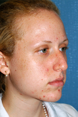 Richard Davis, MD Primary Rhinoplasty: Patient 11, Oblique View, Pre-Op