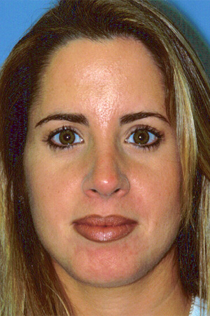 Richard Davis, MD Primary Rhinoplasty: Patient 12, Front View, Post-Op