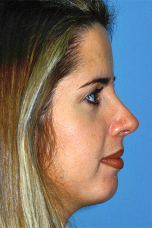 Richard Davis, MD Chin Augmentation: Patient 3, Profile View, Post-Op