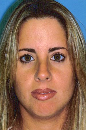 Richard Davis, MD Chin Augmentation: Patient 3, Front View, Pre-Op