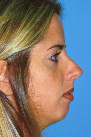 Richard Davis, MD Chin Augmentation: Patient 3, Profile View, Pre-Op