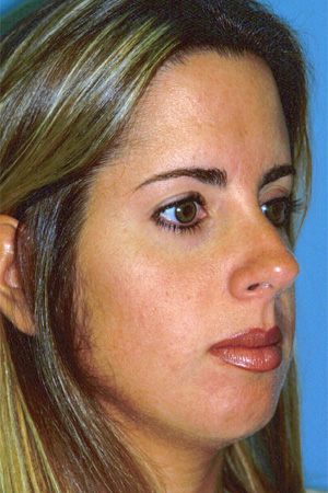 Richard Davis, MD Chin Augmentation: Patient 3, Oblique View, Pre-Op