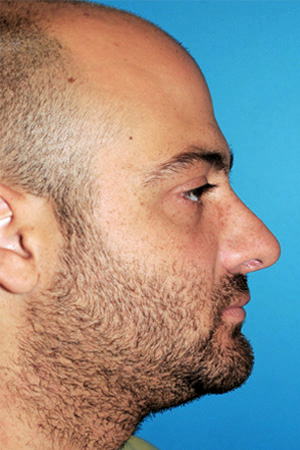 Richard Davis, MD Primary Rhinoplasty: Patient 13, Profile View, Post-Op