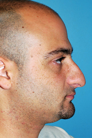 Richard Davis, MD Primary Rhinoplasty: Patient 13, Profile View, Pre-Op