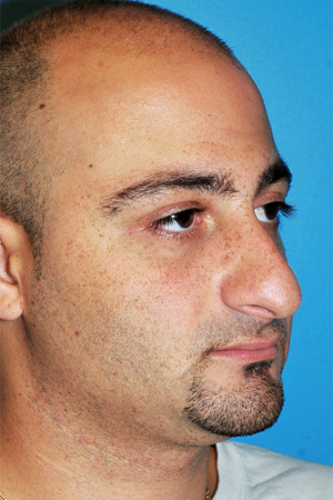 Richard Davis, MD Primary Rhinoplasty: Patient 13, Oblique View, Pre-Op