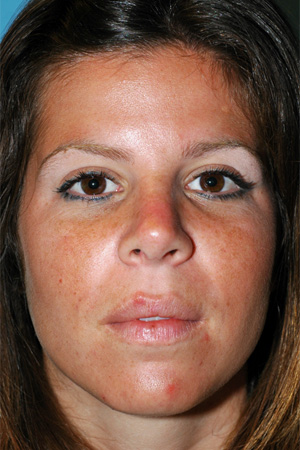 Richard Davis, MD Primary Rhinoplasty: Patient 14, Front View, Post-Op