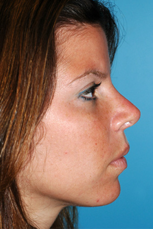 Richard Davis, MD Primary Rhinoplasty: Patient 14, Profile View, Post-Op