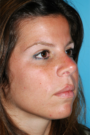 Richard Davis, MD Primary Rhinoplasty: Patient 14, Oblique View, Post-Op