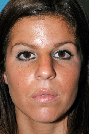 Richard Davis, MD Primary Rhinoplasty: Patient 14, Front View, Pre-Op