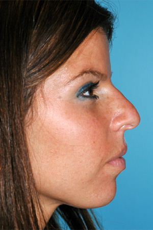 Richard Davis, MD Primary Rhinoplasty: Patient 14, Profile View, Pre-Op