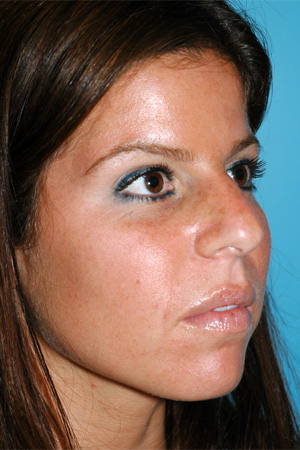 Richard Davis, MD Primary Rhinoplasty: Patient 14, Oblique View, Pre-Op