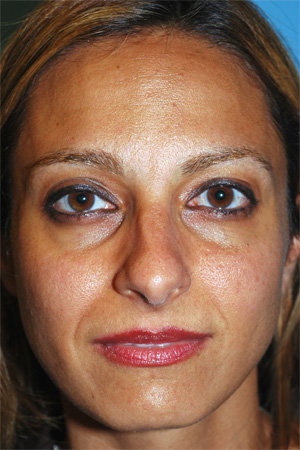 Richard Davis, MD Primary Rhinoplasty: Patient 15, Front View, Pre-Op