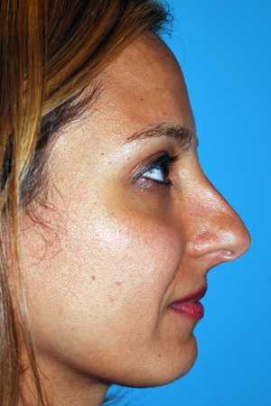 Richard Davis, MD Primary Rhinoplasty: Patient 15, Profile View, Pre-Op