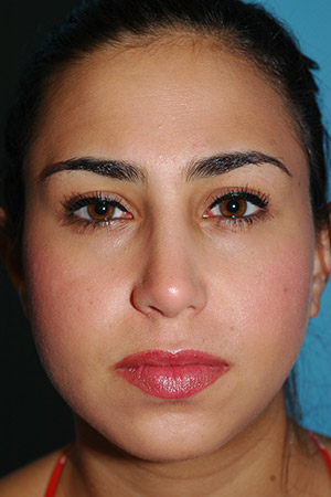 Richard Davis, MD Primary Rhinoplasty: Patient 16, Front View, Post-Op