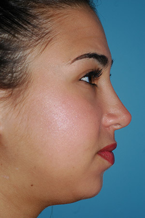 Richard Davis, MD Primary Rhinoplasty: Patient 16, Profile View, Post-Op