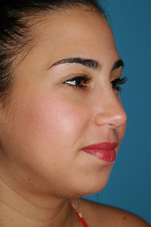 Richard Davis, MD Primary Rhinoplasty: Patient 16, Oblique View, Post-Op