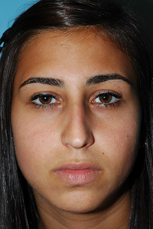 Richard Davis, MD Primary Rhinoplasty: Patient 16, Front View, Pre-Op