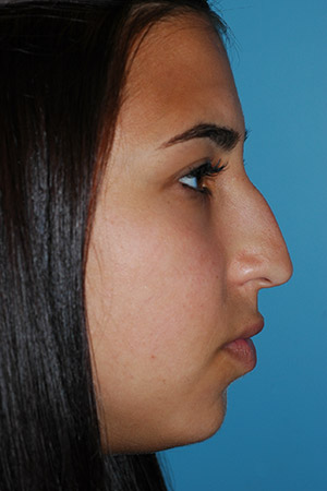 Richard Davis, MD Primary Rhinoplasty: Patient 16, Profile View, Pre-Op