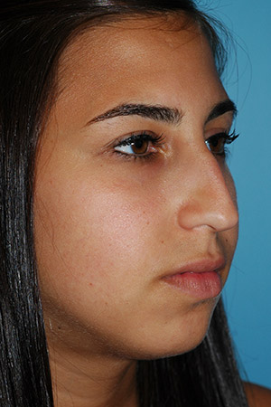 Richard Davis, MD Primary Rhinoplasty: Patient 16, Oblique View, Pre-Op