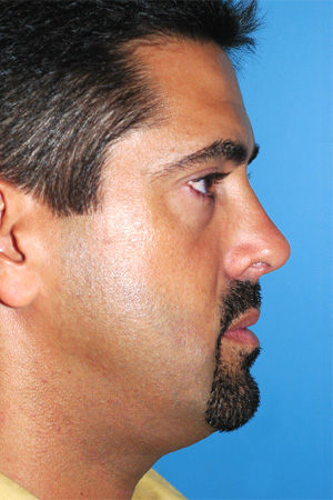 Richard Davis, MD Primary Rhinoplasty: Patient 1, Profile View, Post-Op