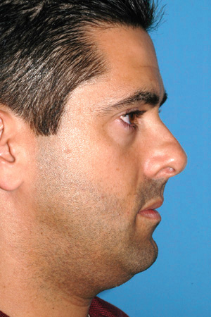 Richard Davis, MD Primary Rhinoplasty: Patient 1, Profile View, Pre-Op