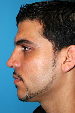 Richard Davis, MD Primary Rhinoplasty: Patient 2, Profile View, Post-Op